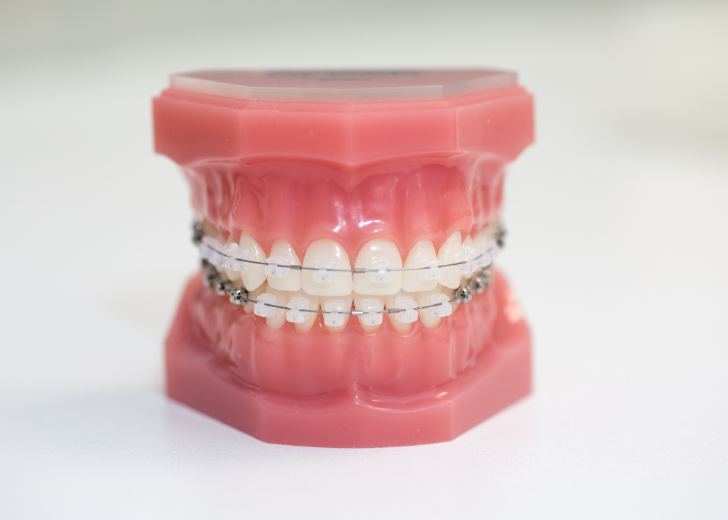Clarity Ceramic Brackets