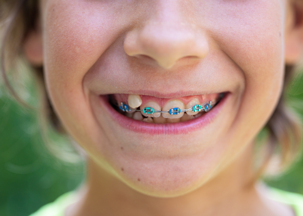 kids braces