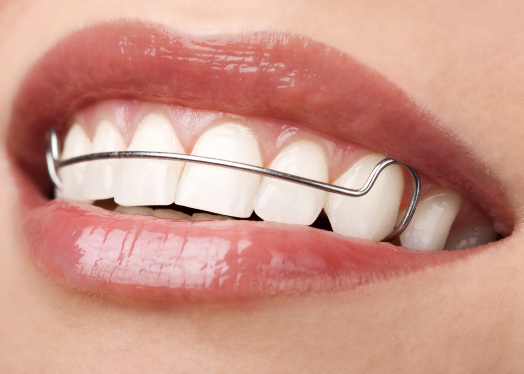 Orthodontic Appliances